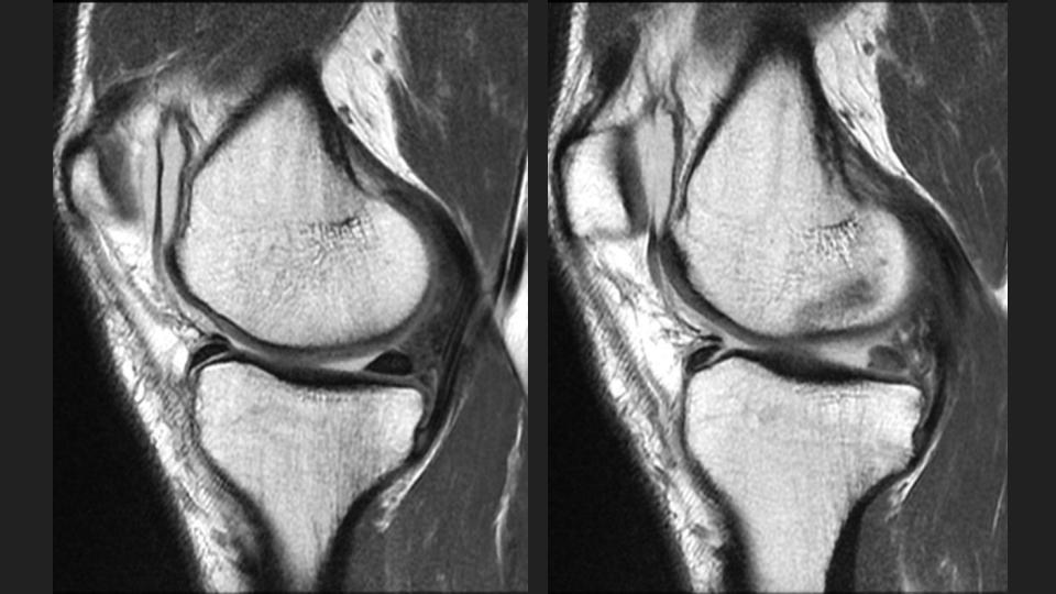 Figure 4 for case posterior horn of medial meniscus ( RID2776 )